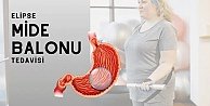 Allurion Mide Balonu